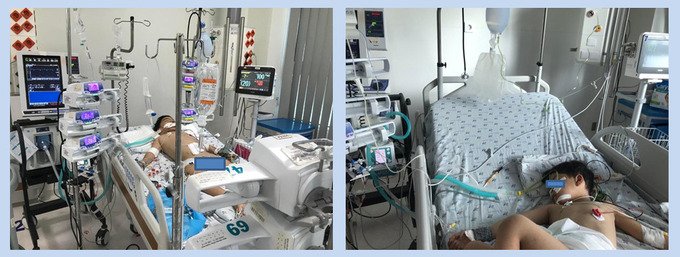 Trẻ N K B M, 5 tuổi, nam, cân nặng 20 kg, sốc sốt xuất huyết Dengue nặng, được chống sốc, thở máy xâm nhập, dẫn lưu màng bụng
