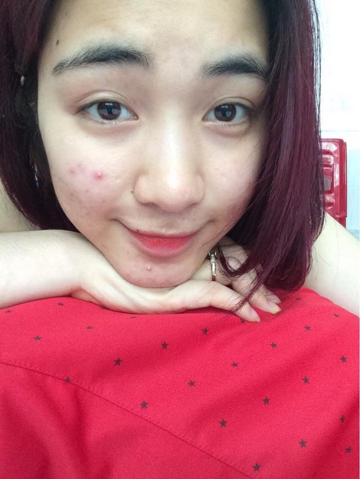 Hòa Minzy từng có thời điểm gương mặt kém sắc vì nổi mụn.