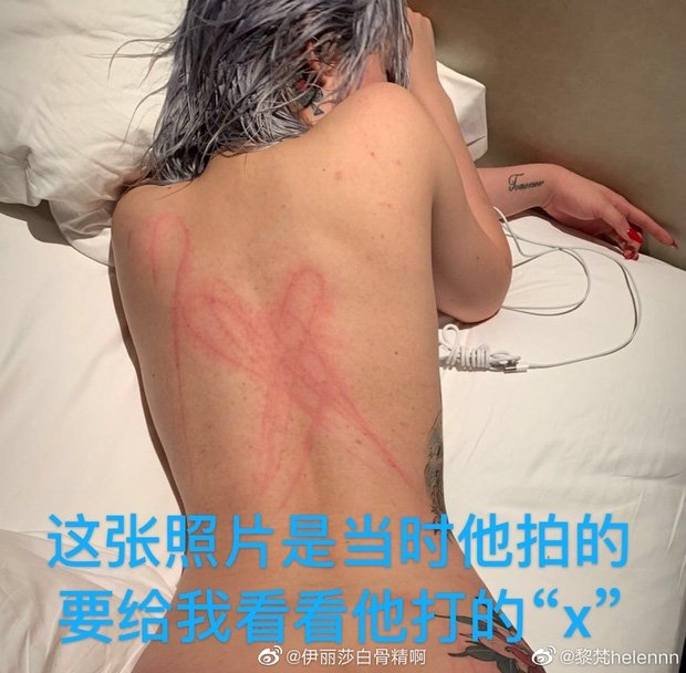 Vết roi hình chữ X trên lưng của Lê Phạn.