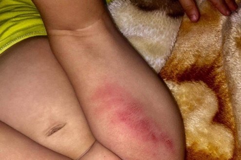 Bé gái 16 tháng tuổi nghi bị bạo hành ở nhà giữ trẻ