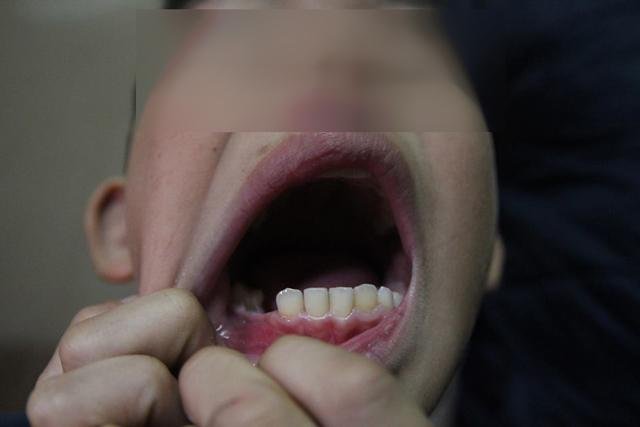 Hà Nội: Bé trai 9 tuổi bị điểm kém, bố dùng dây điện bạo hành dã man