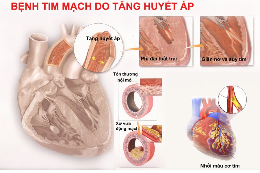 huyet-ap-cao-la-gi-va-huyet-ap-cao-nguy-hiem-nhu-the-nao