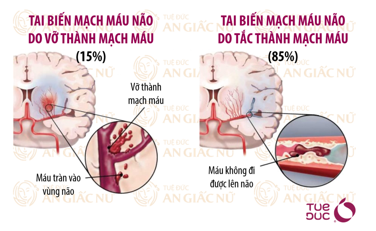 tai-bien-mach-mau-nao-la-gi-va-tai-bien-mach-mau-nao-nguy-hiem-nhu-the-nao