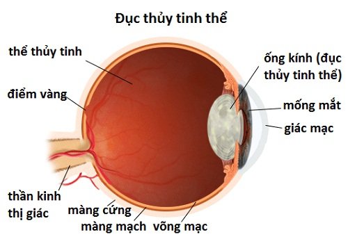 duc-thuy-tinh-the-la-gi-va-duc-thuy-tinh-the-neu-de-lau-de-gay-mu-loa