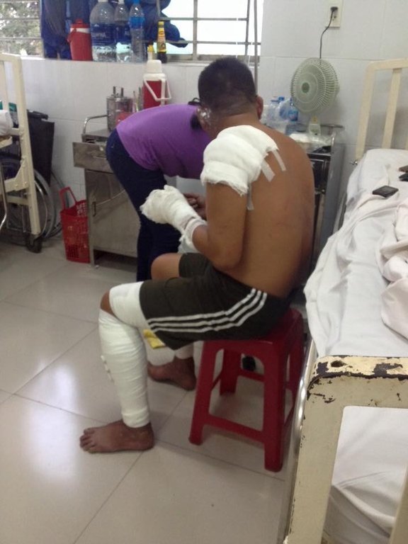 Nữ phóng viên chụp bức ảnh anh lính cứu hỏa bị bỏng tuột da tay: 