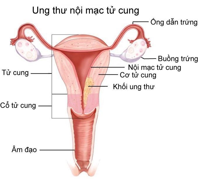 lac-noi-mac-tu-cung-la-gi-va-lac-noi-mac-tu-cung-co-nguy-hiem-khong
