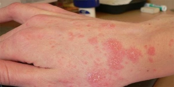 Eczema là bệnh gì?
