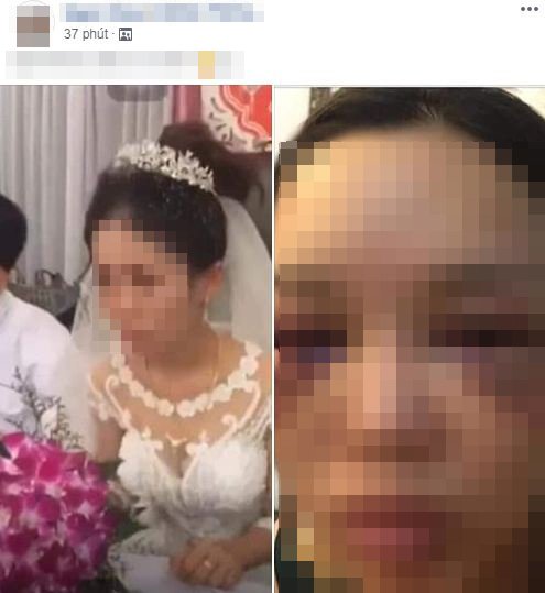 Hình ảnh cô gái bị bầm tím mặt được cho là nhân vật trong clip cô dâu không cho chú rể hôn lan truyền trên mạng xã hội.