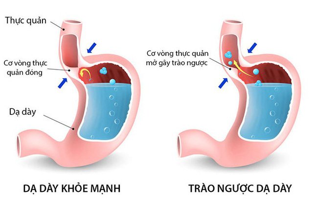 Gerd là gì và có gây nguy hiểm hay không?