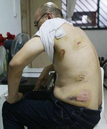 Những vết thương trên lưng ông Zhong Zhengye do bị bà Phan Thi Ngoc Dung hành hung. Ảnh: Stomp