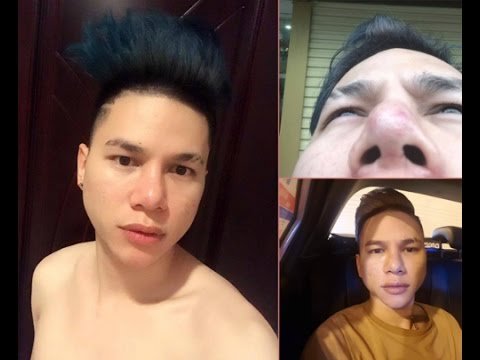 truoc-viet-anh-nhieu-sao-viet-tung-phau-thuat-hong