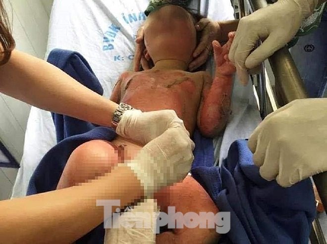 Tình tiết mới vụ 3 cháu bé mầm non bị bỏng khi học kỹ năng