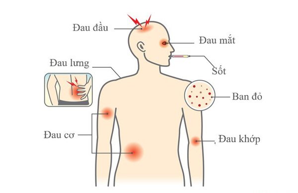 hinh-anh-sot-xuat-huyet-sot-xuat-huyet-bao-lau-thi-khoi