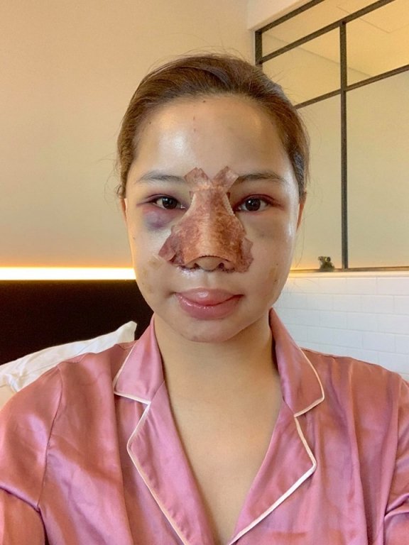 Gương mặt như bị ong đốt của Lưu Đê Ly khi ra viện. 