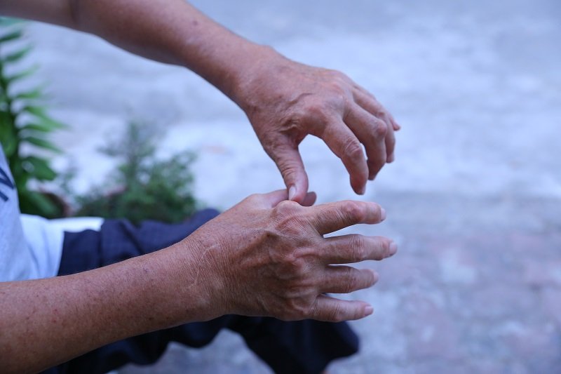 Đại tá Nguyễn Thành Lập và những biến chứng của gout.