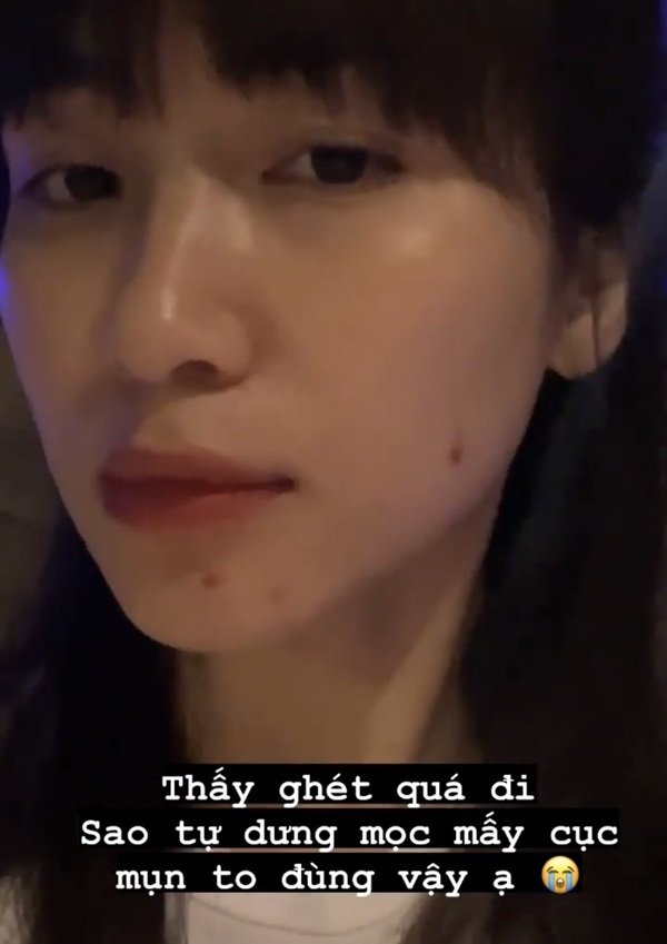 Hòa Minzy kêu trời vì mặt mụn