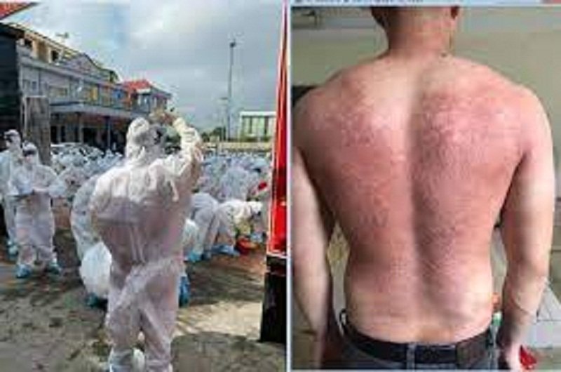 Ảnh tấm lưng phồng rộp của y bác sĩ tâm dịch Bắc Giang khiến dân mạng xót xa.