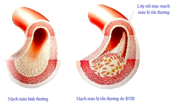 Bệnh tiểu đường và biến chứng mạnh máu