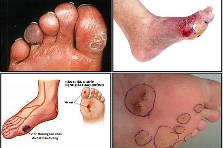 Nhiễm trùng ở bàn chân là gì?
