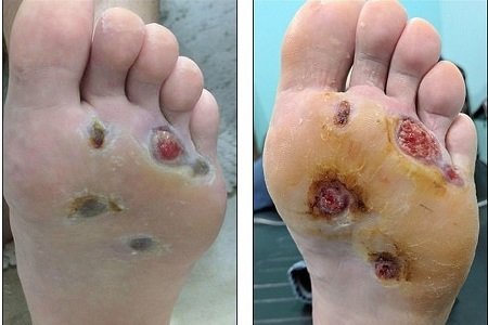 Dấu hiệu nhiễm trùng ở bàn chân